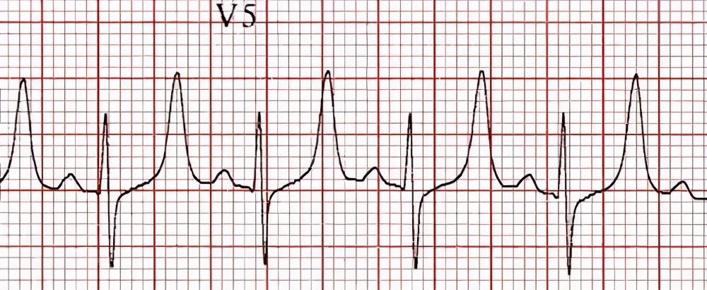 高血钾病能彻底治愈吗,高血钾最危险的症状