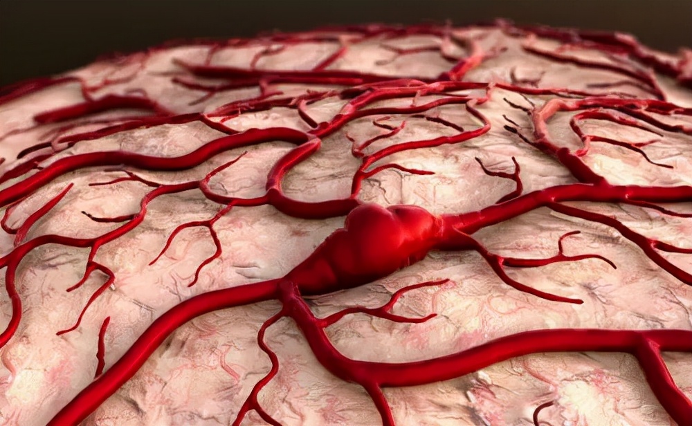 脑梗塞五个病因,多发腔隙性脑梗塞中医能治好吗