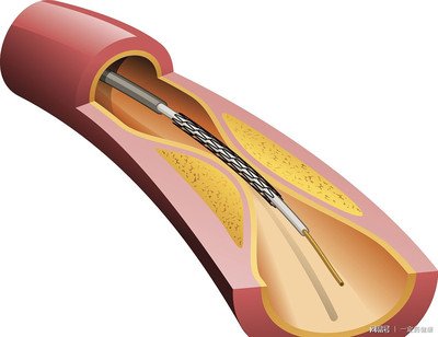 心肌梗死后多久可以恢复运动,心肌梗死后一个月还用支架吗