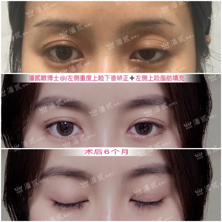 上睑下垂手术是不是永远闭不上眼,做了上睑下垂手术后怎么护理眼睛