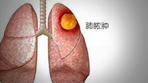 肺癌引发肺脓肿可以一并手术吗,肺脓肿引流手术难度大吗