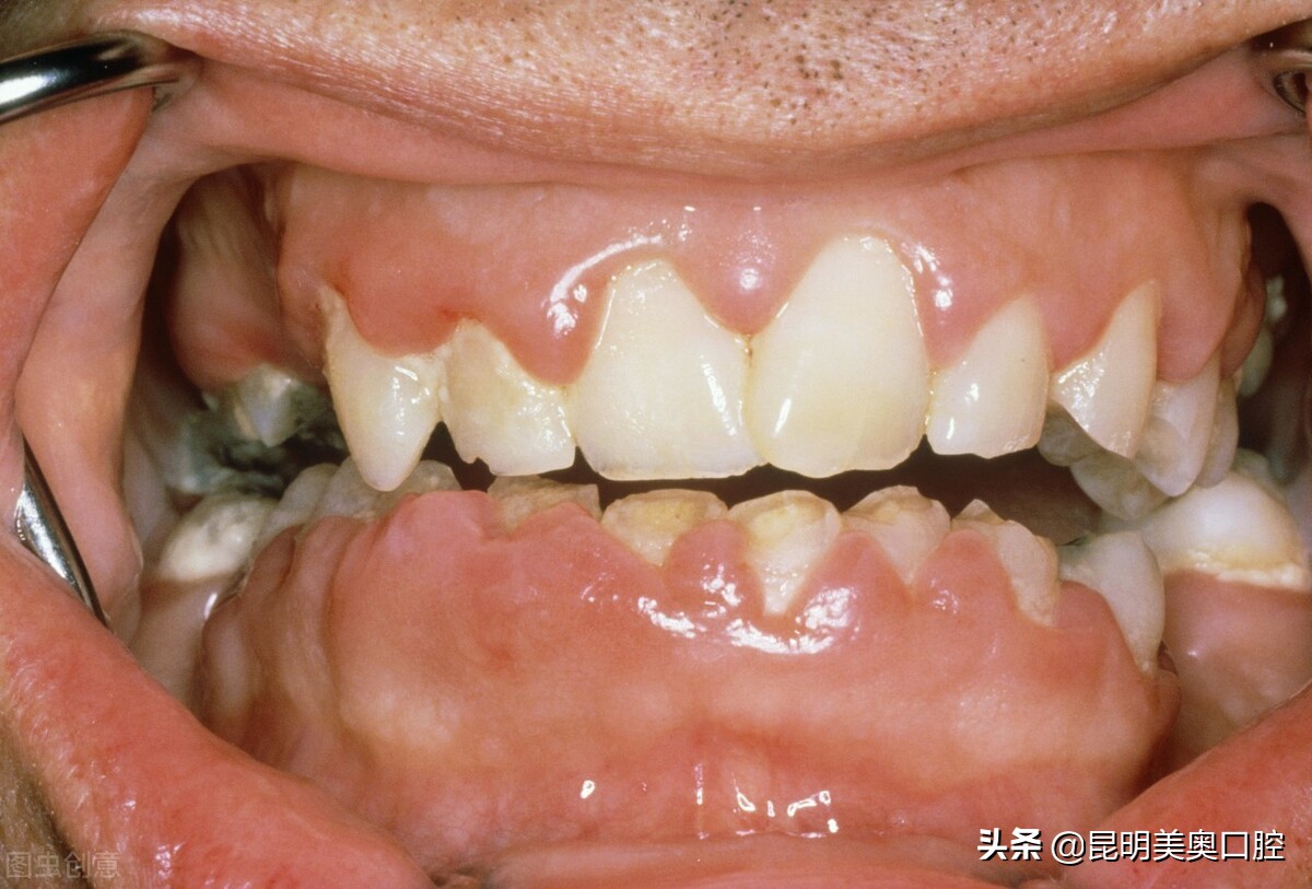 牙龈萎缩导致牙齿脱落怎么办,牙龈萎缩牙齿脱落如何治疗