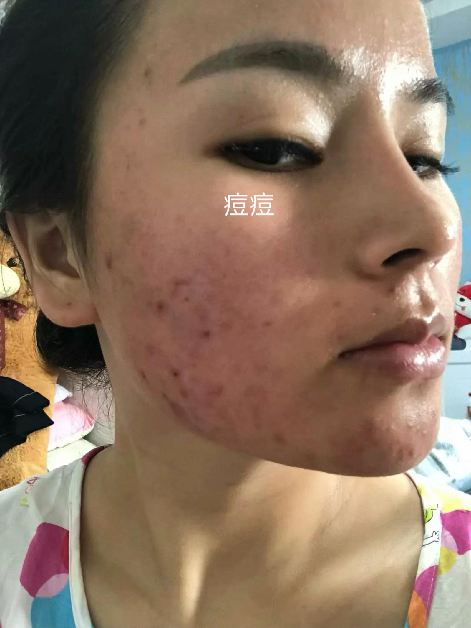 30天快速消痘印,30天祛痘效果最好的方法