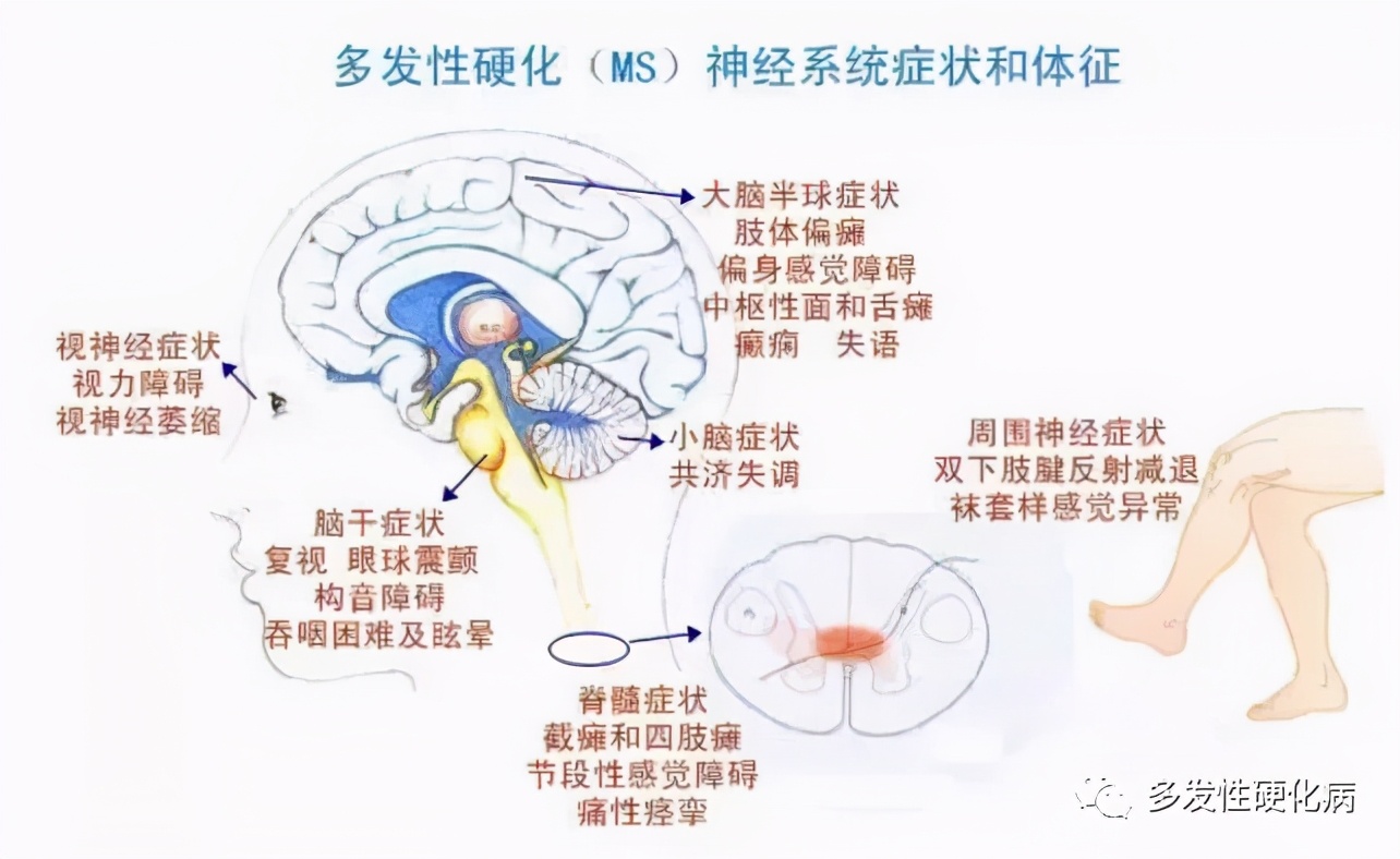 中医治疗多发性硬化方法,多发性硬化中药治疗方法