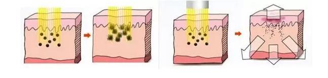 激光美白最真实的经历,激光美白为什么要一个月才有效果