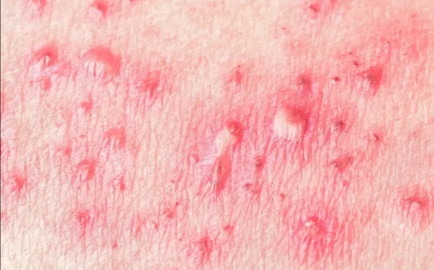 传播性极强的生殖器疱疹会影响生育，患病后要做好这三件事