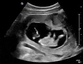 胎动辨宝宝状况,孕妇胎动频繁胎动信号很重要