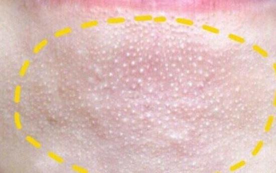 如何彻底消灭在痘痘里的螨虫,痘痘里面有米粒怎么全部去除