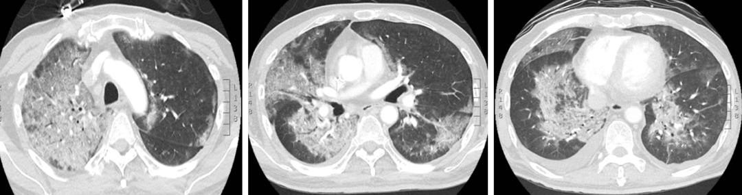 间质性肺病治疗后会加重吗,化疗后肺部间质性的病变