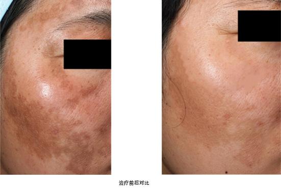 医美小课堂治疤痕,医美小课堂斑痣