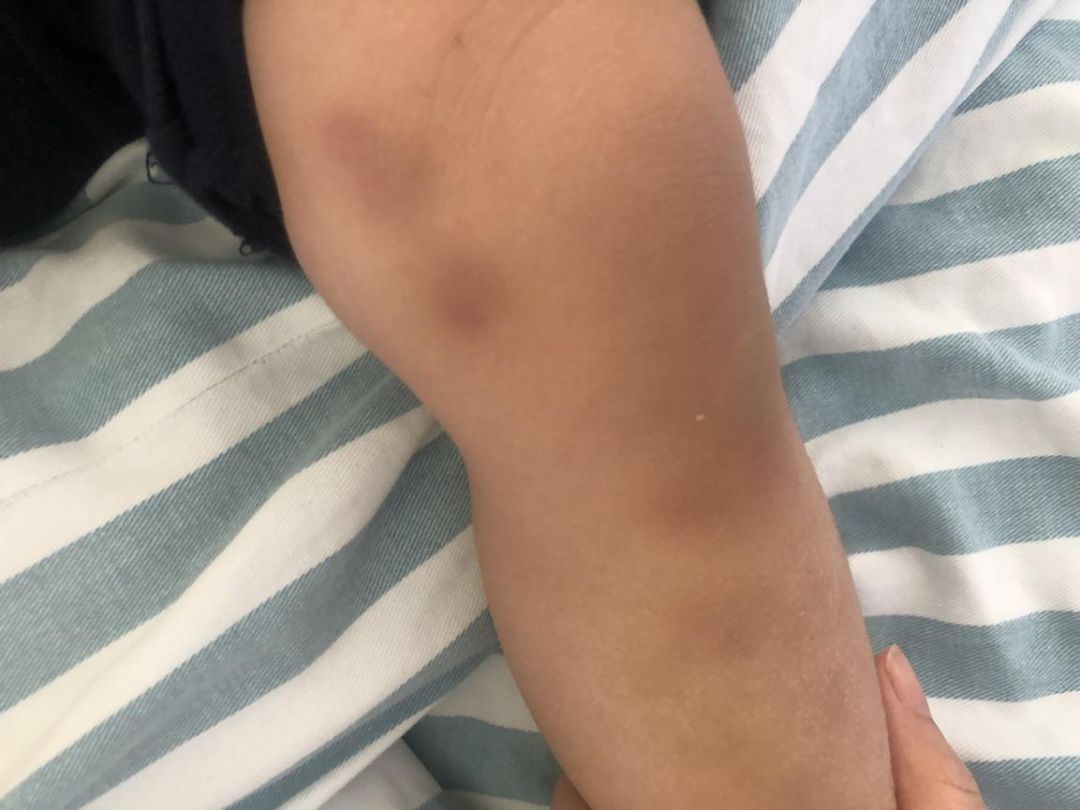 深圳2兄妹身上频现“离奇淤青”，医生：可能是吃出来的！咋回事