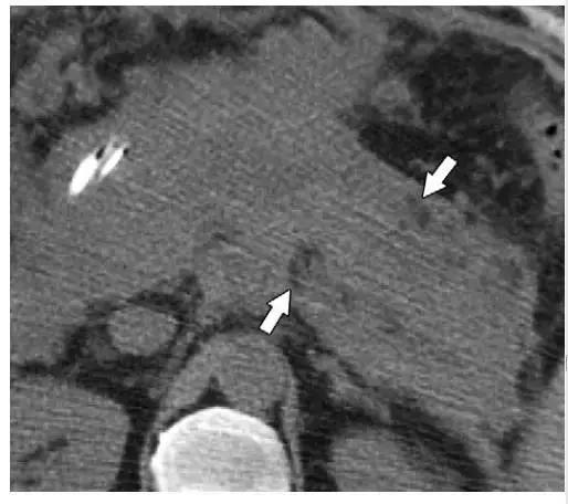 简述急性胰腺炎影像学表现,有关急性胰腺炎疼痛的图片
