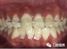 门牙折断牙根完好怎么办,门牙意外脱落怎么修复