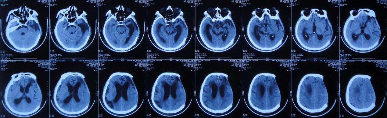 颅脑外伤术后脑积水,脑外伤脑积水颅骨缺失