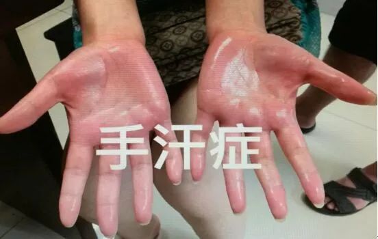 手汗不是很多怎么回事,手汗多是一种病吗怎么治