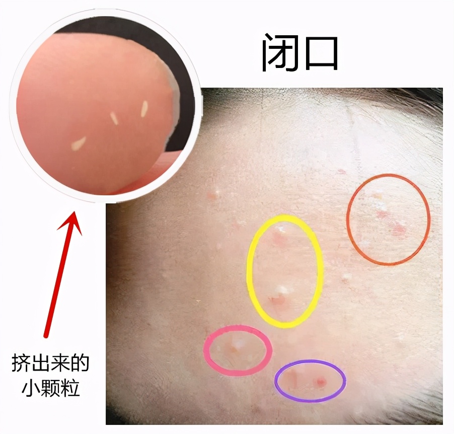 被黑头粉刺挤出来的痘痘怎么办,被粉刺闭口困扰怎么办