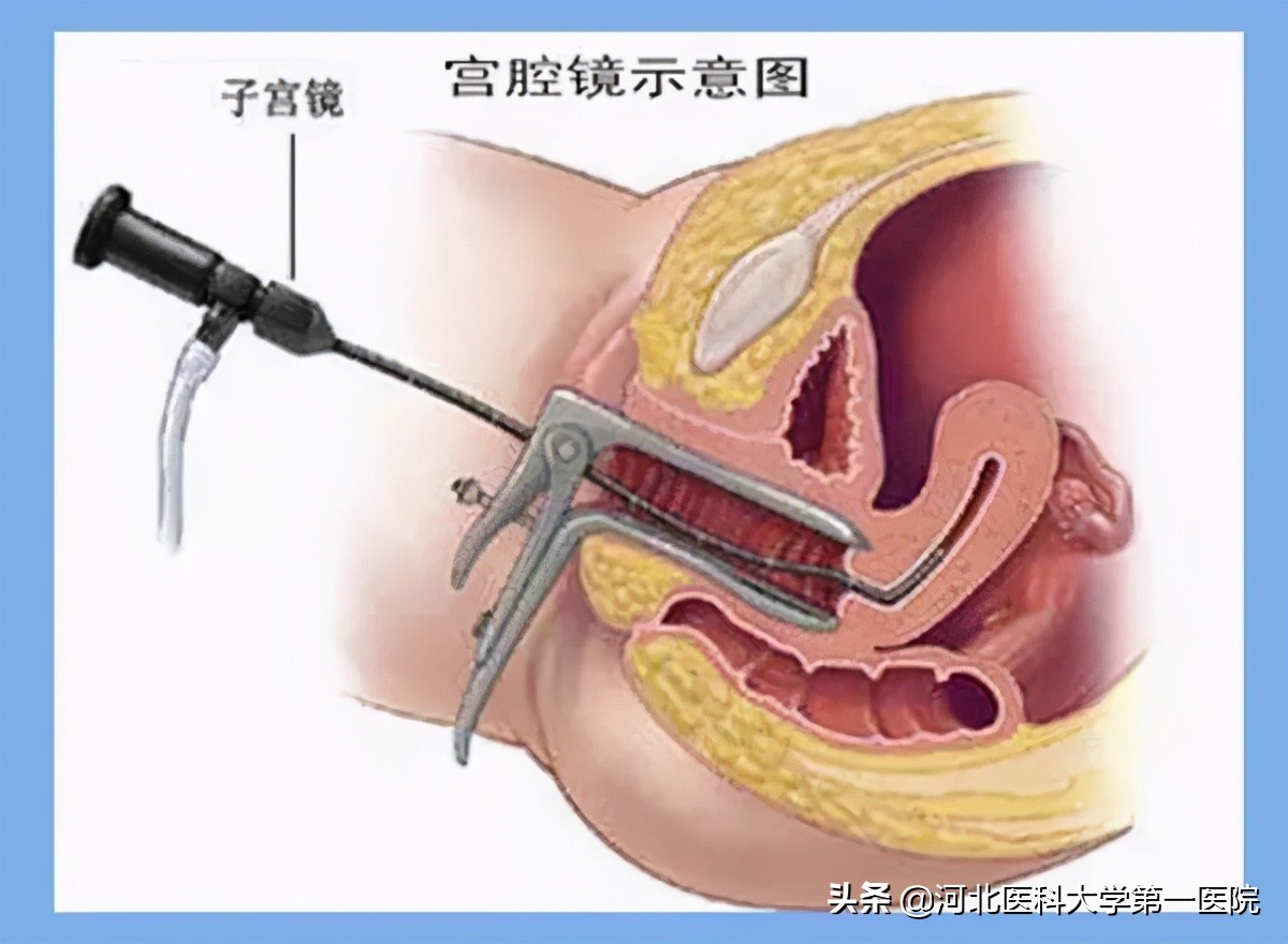 微创切除子宫宫腔镜好还是开刀好,探秘微创手术