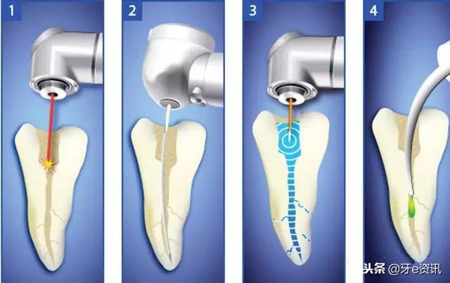 补牙和根管治疗有哪些区别,补牙和根管治疗有何不同