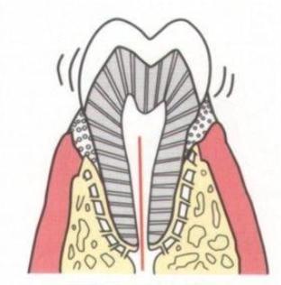 如果牙齿松了几个月了该怎么办,牙齿松了不要管它可以吗