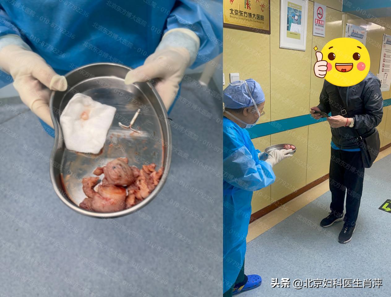 东方博大医院张秀春治疗腺肌症,北京东方博大医院治疗腺肌症