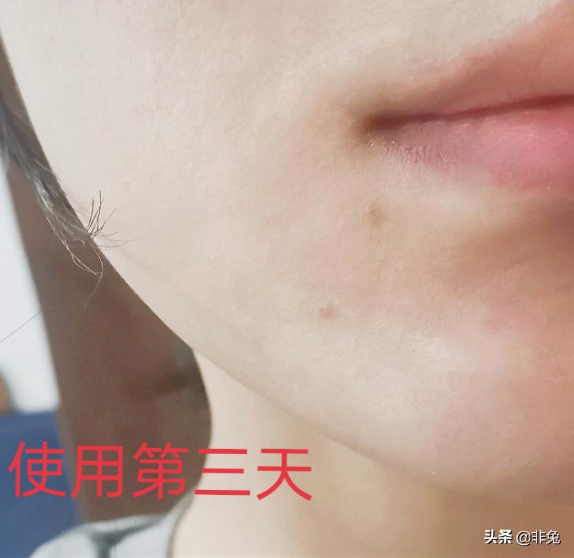 祛痘仪测评真实推荐,祛痘实测