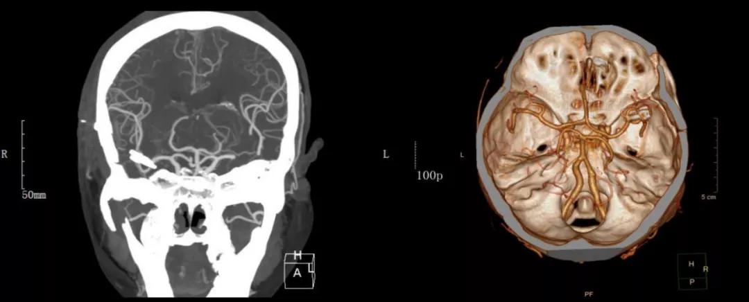 突然头疼要炸了怎么回事,睡觉突然头疼剧烈要炸了