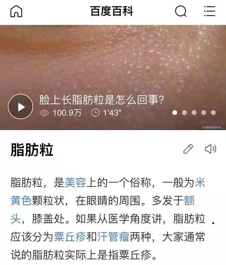 黑头粉刺怎么去都消除不了,去闭口黑头粉刺最有效的方法