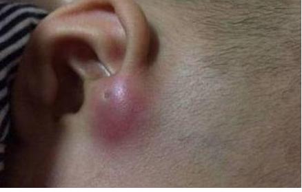 宝宝耳朵长了两个肉球想手术,小孩耳朵长肉疙瘩多大可以手术