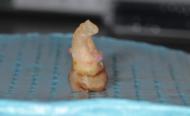 拔智齿根断在里面有什么危害,拔智齿牙根断在里面会怎么样