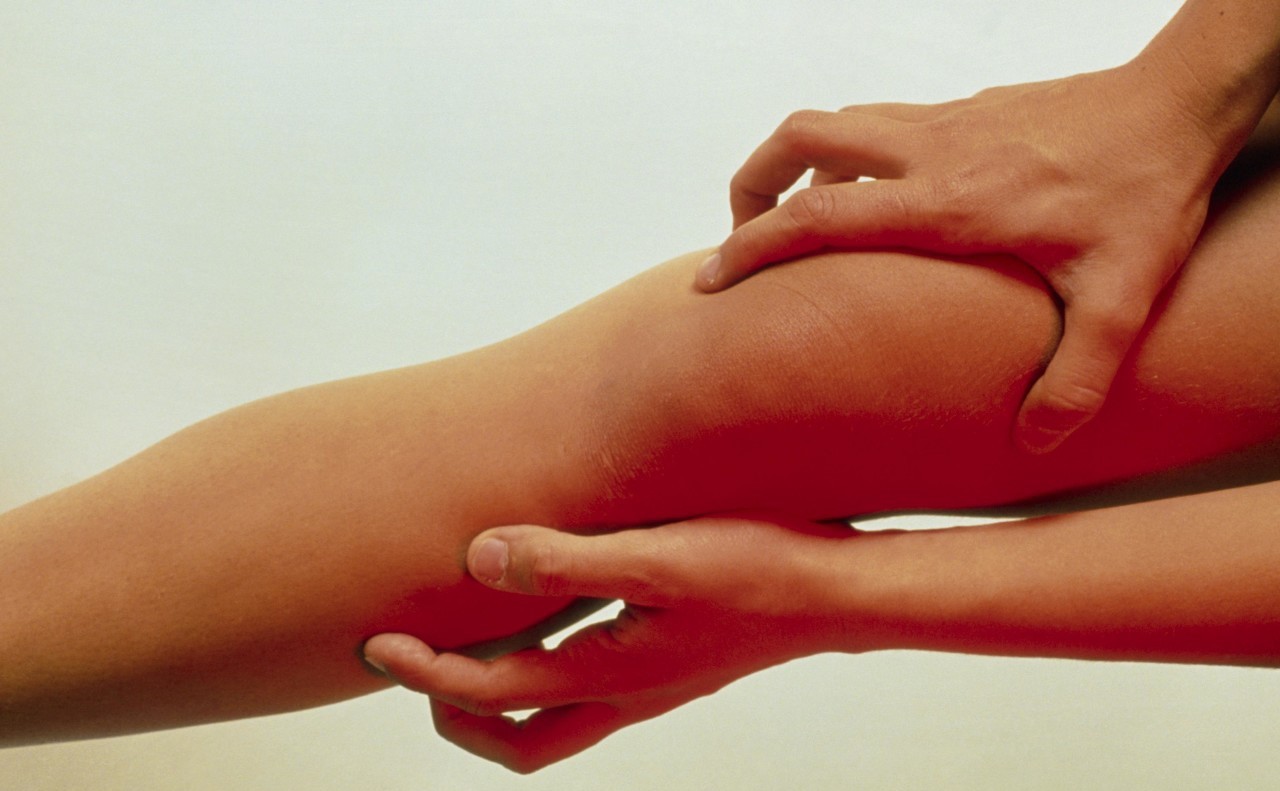 小腿肌间静脉丛血栓起病隐匿，患者通常临床表现为小腿疼痛及肿胀