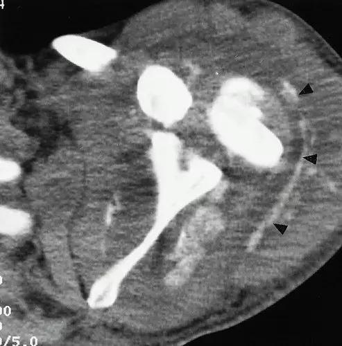 神经性骨关节病,神经性关节炎症状图片