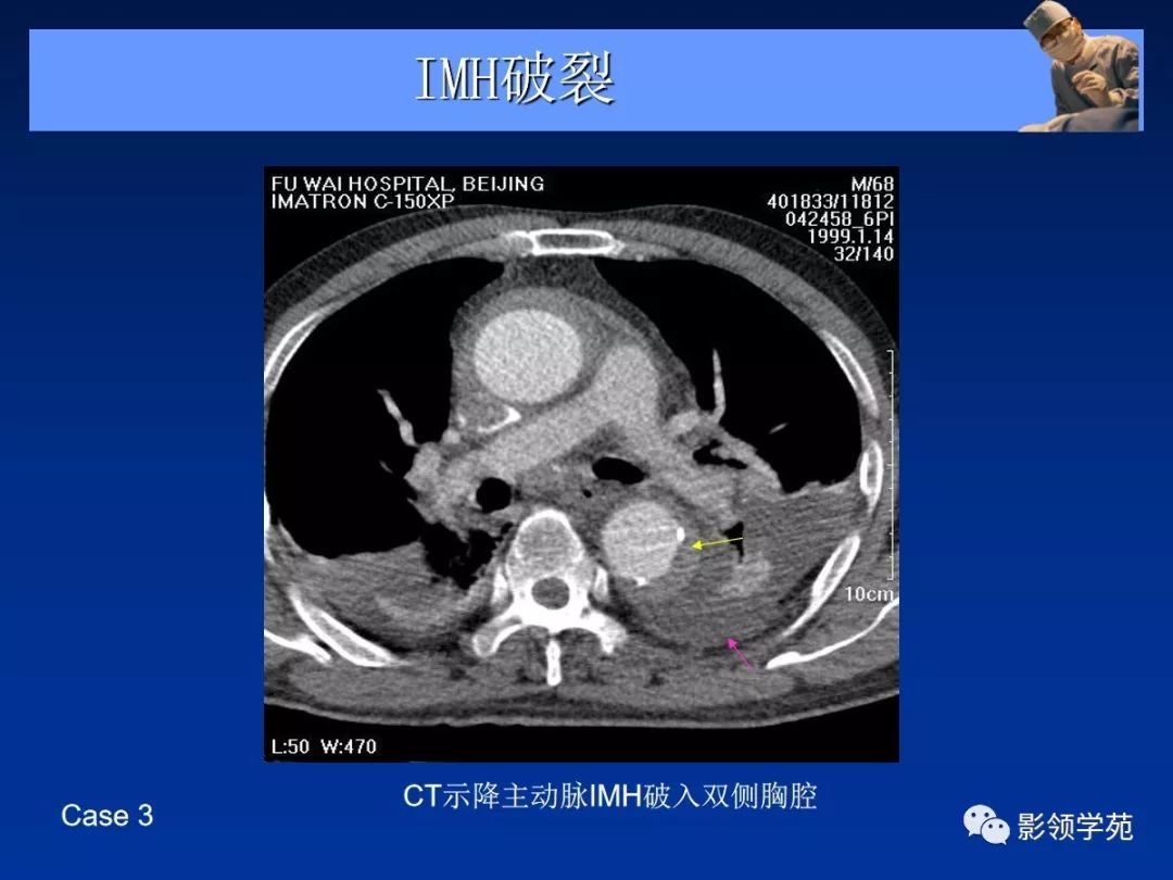 主动脉夹层壁间血肿如何鉴别,主动脉夹层血肿溃疡
