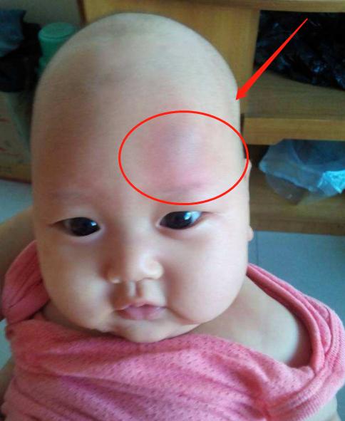 小孩摔伤后妈妈少做一件事,小孩摔伤头部该怎么做