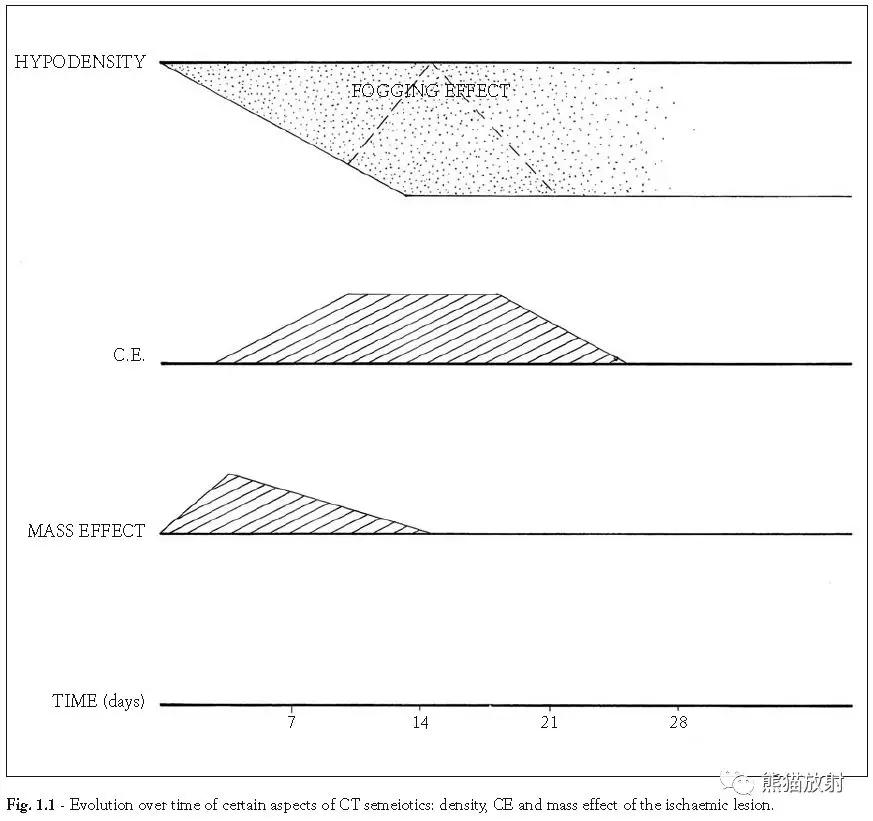 各部位脑梗死ct影像讲解,脑梗死ct影像最简单的是什么表现
