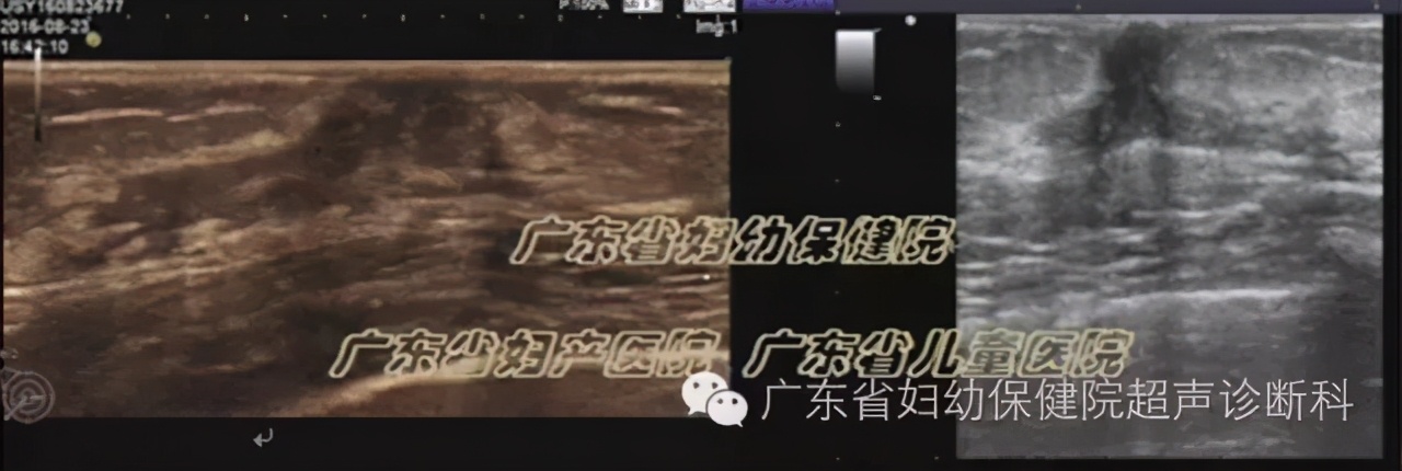 青春期乳腺正常情况,乳腺发育的特征