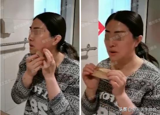 想要垫下巴│材料怎么选？手术疼不疼，过程怎样？听她亲口跟你说