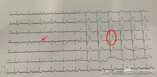 心电图危险指数两颗星,高危心电图的识别