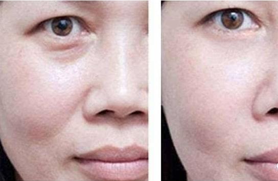 27岁有法令纹怎么改善做什么项目,28岁法令纹凹陷怎么改善