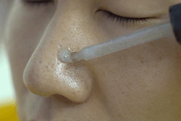 长黑头VS不长黑头差距这么大?精致女孩如何绕过黑头这道坎?