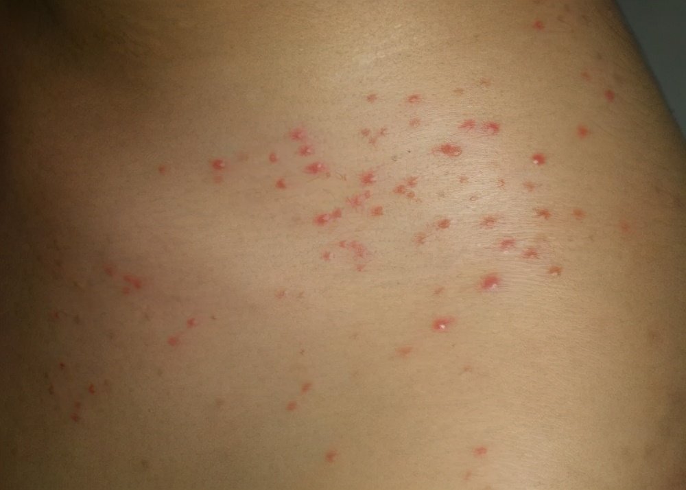 过敏性紫癜性肾炎,过敏性紫癜性肾炎的临床表现