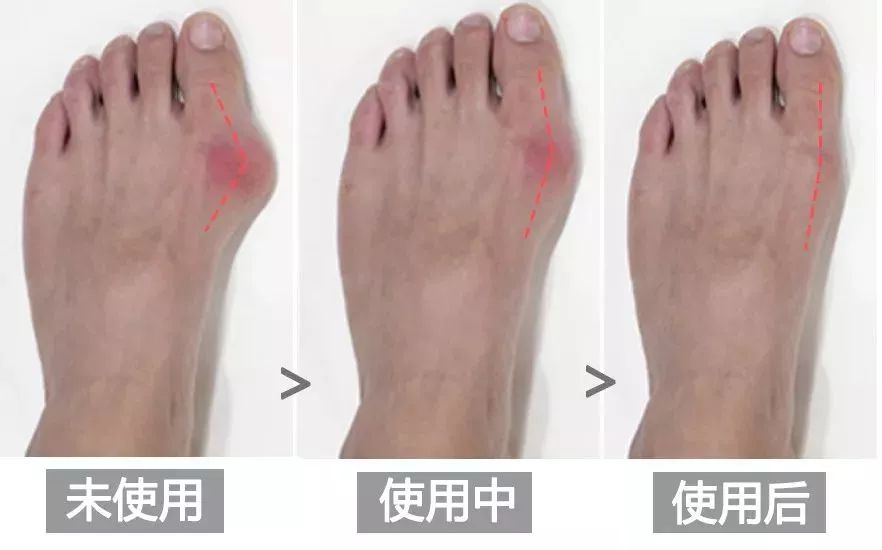 脚趾超级痛,轻度脚趾外翻如何矫正
