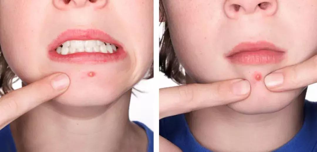 痘痘不小心破了怎么避免留坑,三角区的痘痘千万不要碰