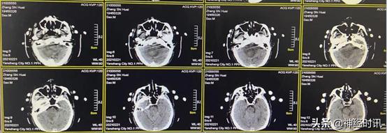高血压小脑出血治愈率多大,高血压导致小脑出血