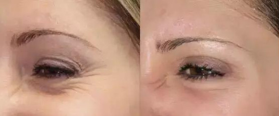 肉毒素打鱼尾纹范围大注射点图解,鱼尾纹肉毒素的危害和后遗症