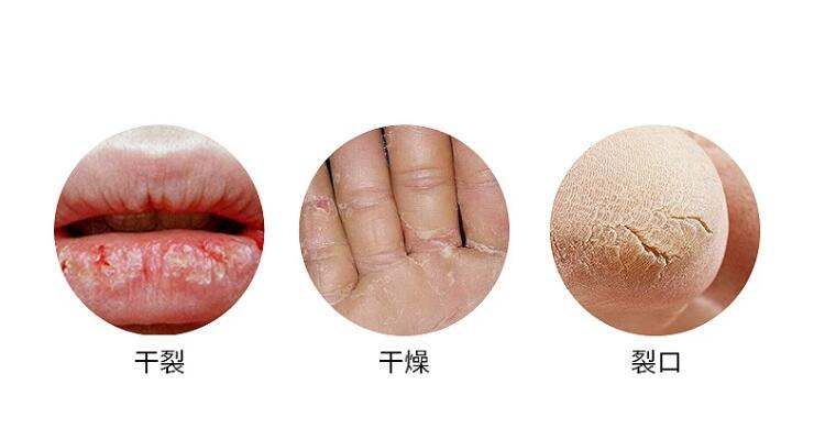手足皲裂不可怕,选对防裂膏是关键