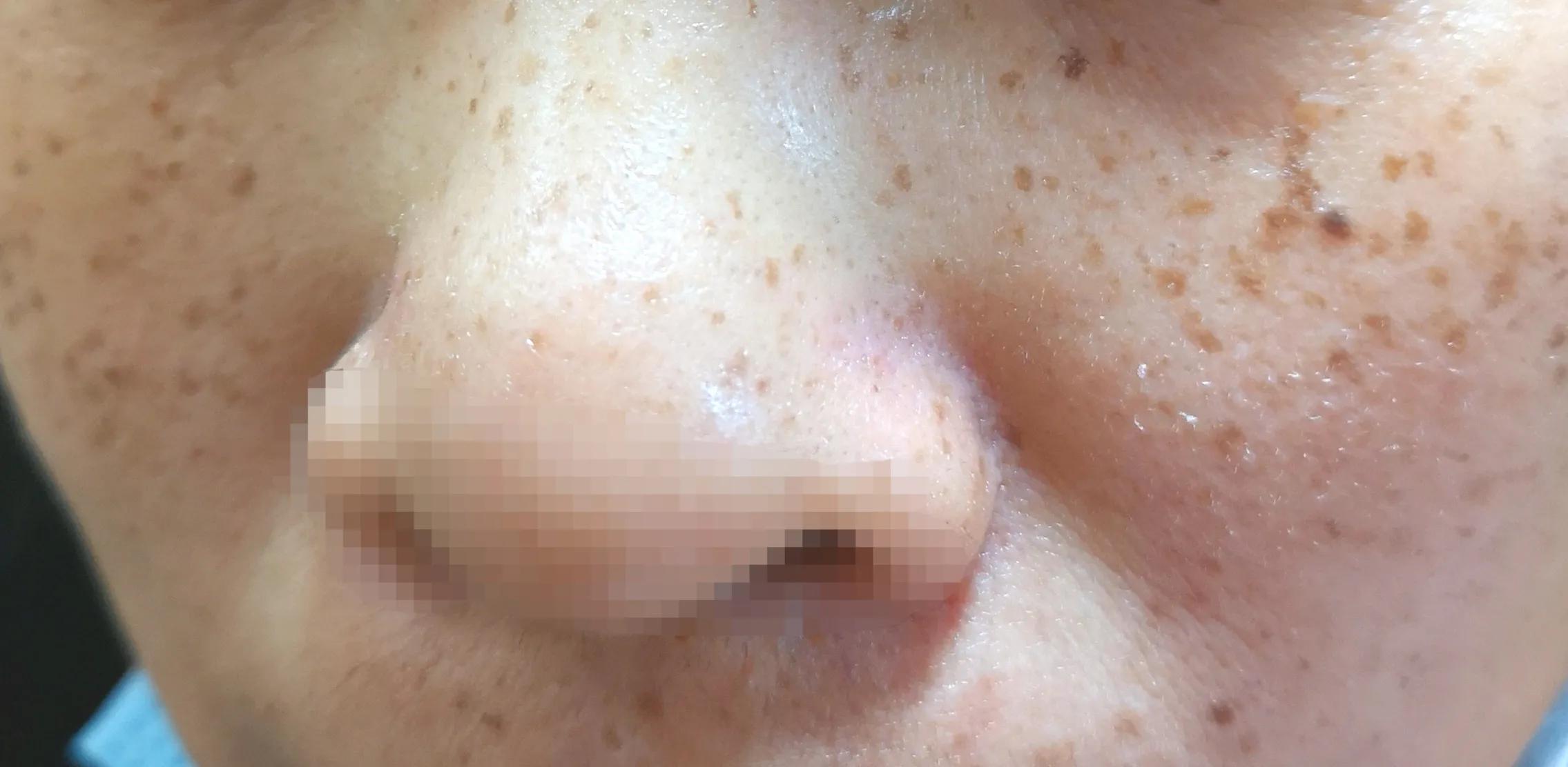 脸上的斑分为几种类型,脸上常见的6种斑