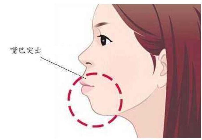 龅牙和深覆合有什么区别,龅牙矫正出现深覆合正常吗