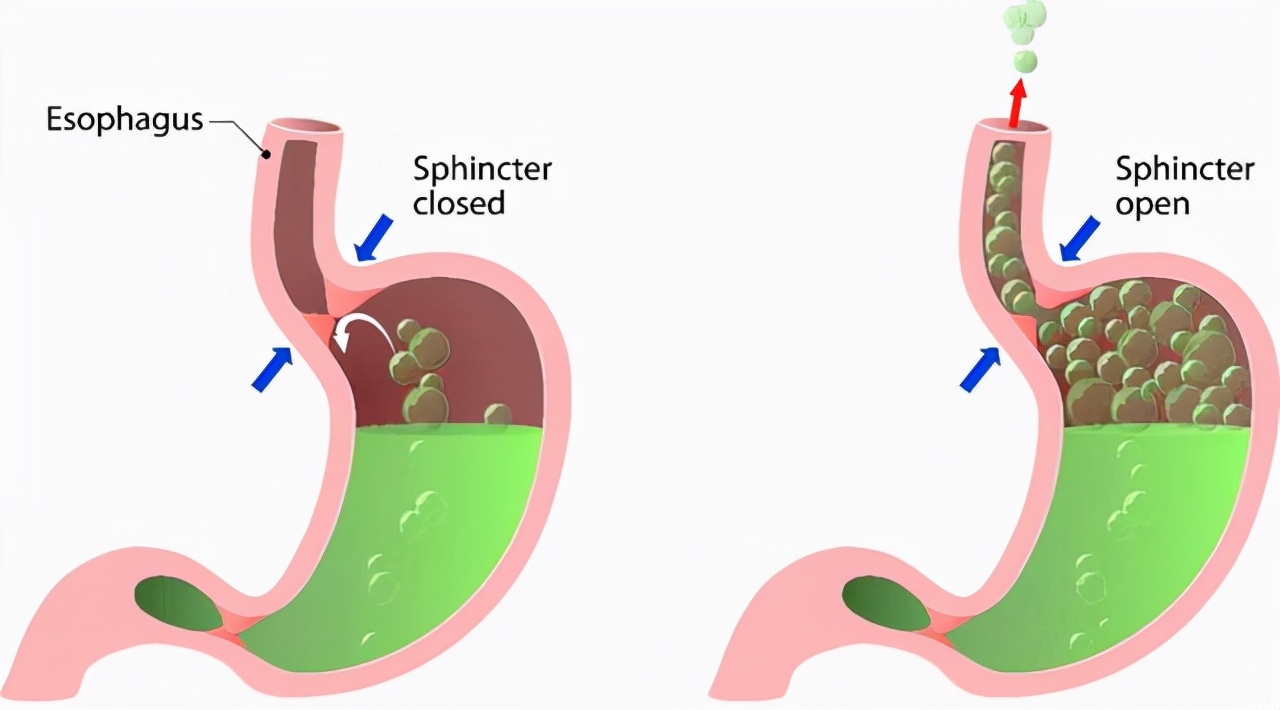 反酸烧心吃什么药可缓解,经常烧心反酸食物调理