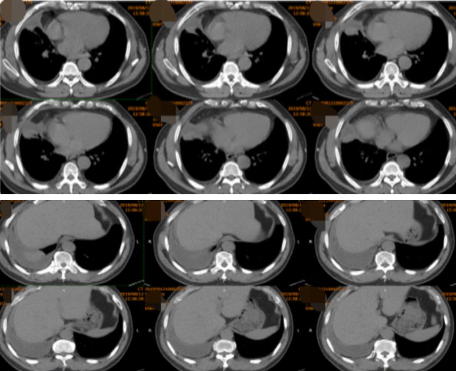 56岁男性发现双肺数百个结节,肺部肿块伴胸腔积液