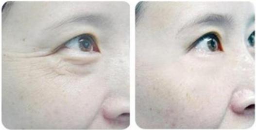 眼部有皱纹很显老教你一招,鱼尾纹显老还是眼部细纹显老